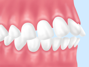 上下顎前突（じょうげがくぜんとつ）